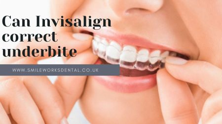 Invisalign correct underbite