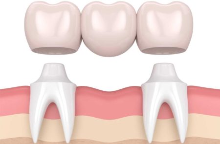 bridge denture