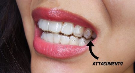 Invisalign Attachments