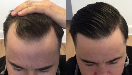 Hair transplant