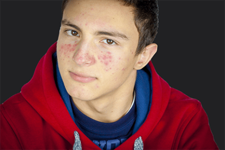 Acne Behandeling