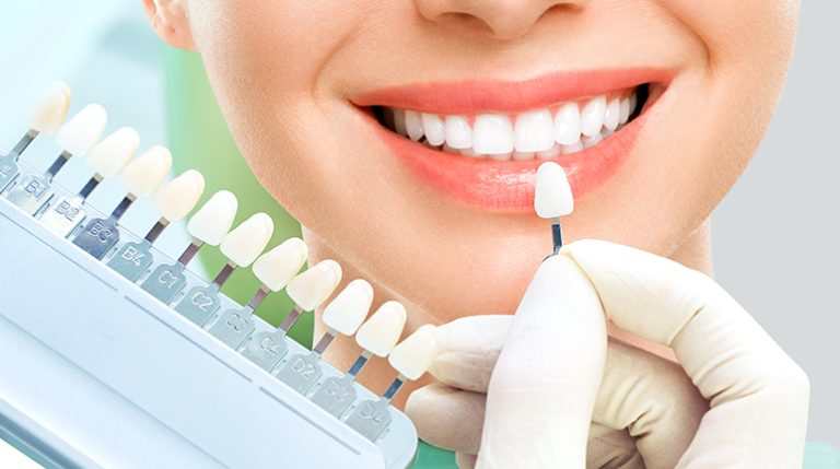 Whitening Dental Fillings