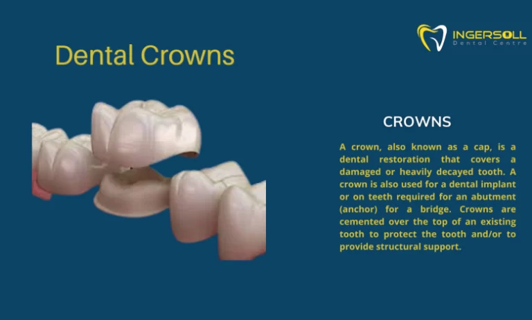 Dental Crown