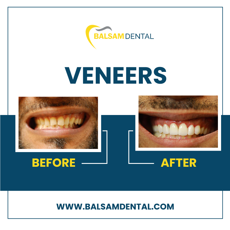 veneers cost Toronto