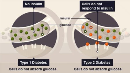 Type 2 Diabetes Stem Cell Therapy India