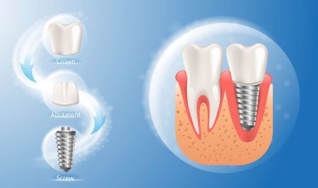 dental implants cost