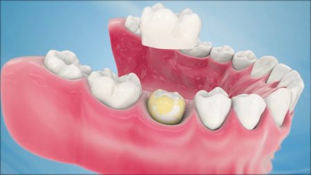 dental crown cost canada