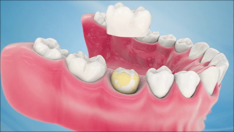 dental crown cost canada