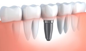 dental implants cost