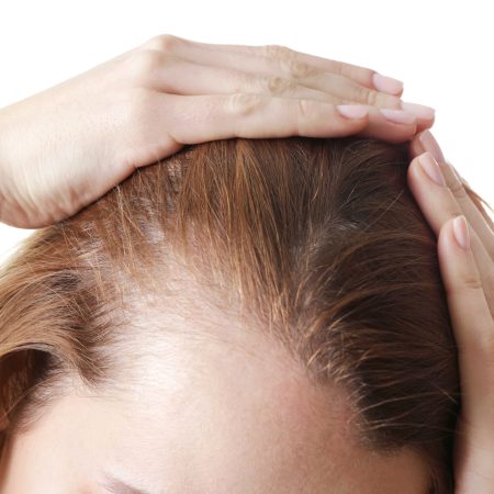 Female Hair Loss