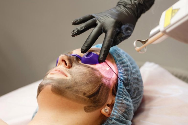 laser carbon peel treatment in dubai