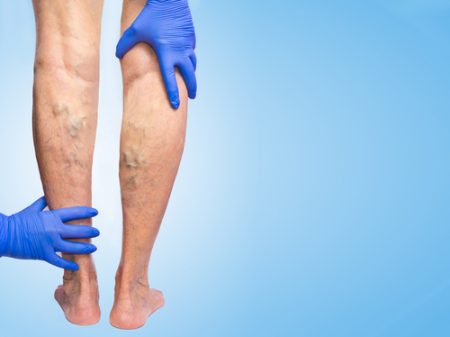 Varicose Vein