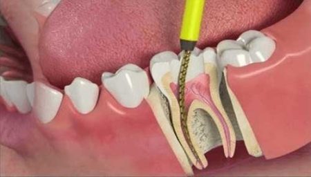 Root Canal Symptoms