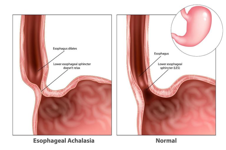 achalasia