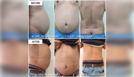 Liposuction Surgery Cost In Jaipur