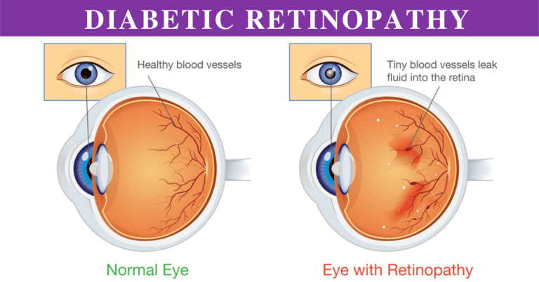 Diabetic retinopathy image