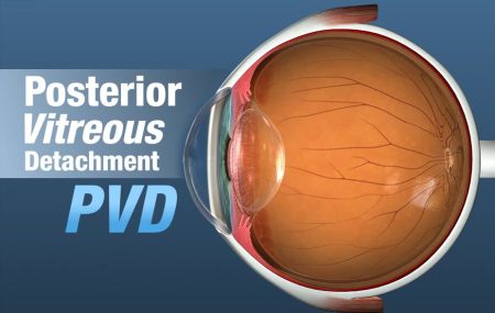 Posterior Vitreous Detachment featured image