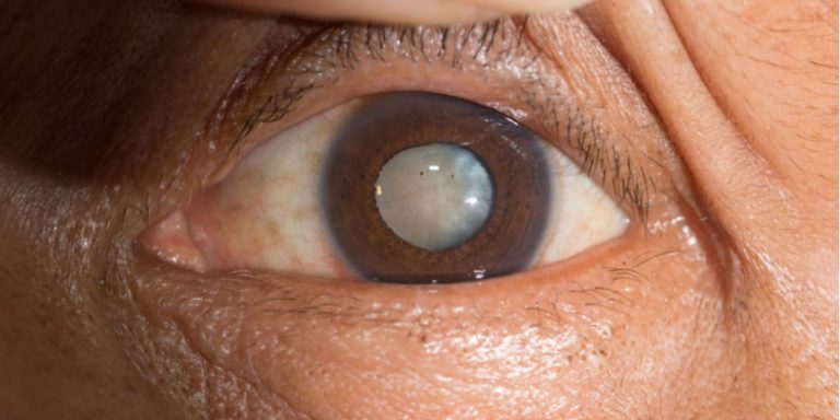 cataract featured image