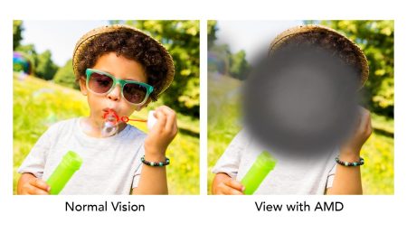 Age Related Macular Degeneration featured image