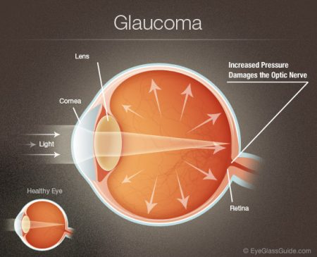 Types and effects of Glaucoma featured image.