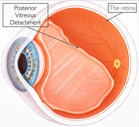 Posterior Vitreous Detachment featured image