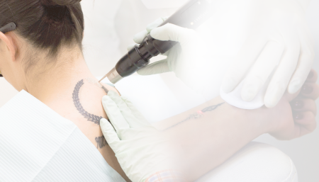 tattoo removal